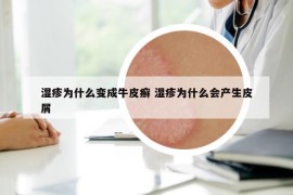 濕疹為什么變成牛皮癬 濕疹為什么會(huì)產(chǎn)生皮屑