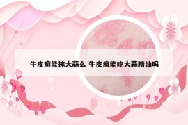 牛皮癬能抹大蒜么 牛皮癬能吃大蒜精油嗎