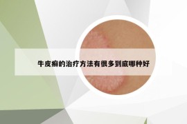 牛皮癬的治療方法有很多到底哪種好