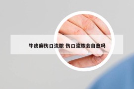 牛皮癬傷口流膿 傷口流膿會自愈嗎