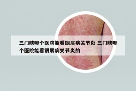三門峽哪個醫(yī)院能看銀屑病關(guān)節(jié)炎 三門峽哪個醫(yī)院能看銀屑病關(guān)節(jié)炎的