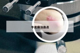 牛皮癬沒血點