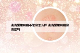 點(diǎn)滴型銀屑病不管會(huì)怎么樣 點(diǎn)滴型銀屑病會(huì)自愈嗎