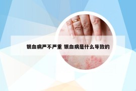 銀血病嚴(yán)不嚴(yán)重 銀血病是什么導(dǎo)致的