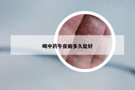 喝中藥牛皮癬多久能好