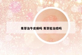 麥芽治牛皮癬嗎 麥芽能治癌嗎