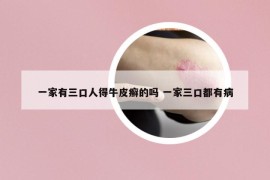 一家有三口人得牛皮癬的嗎 一家三口都有病