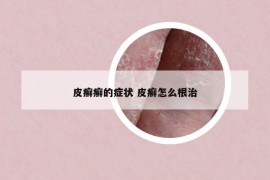 皮癬癬的癥狀 皮癬怎么根治