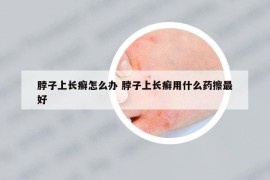 脖子上長(zhǎng)癬怎么辦 脖子上長(zhǎng)癬用什么藥擦最好