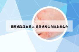 銀屑病發(fā)生在臉上 銀屑病發(fā)生在臉上怎么辦