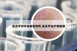 皮炎平對牛皮癬有效嗎 皮炎平治療銀屑病