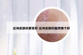 達州皮膚科那家好 達州皮膚科醫(yī)院哪個好