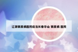 遼源銀屑病醫(yī)院應(yīng)當(dāng)長春華山 銀屑病 醫(yī)院