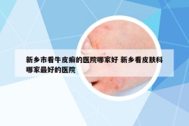 新鄉(xiāng)市看牛皮癬的醫(yī)院哪家好 新鄉(xiāng)看皮膚科哪家最好的醫(yī)院