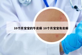 10個(gè)月寶寶的牛皮癬 10個(gè)月寶寶有皮癬