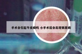 手術會引起牛皮癬嗎 小手術后會出現(xiàn)銀屑病