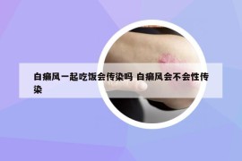 白癩風(fēng)一起吃飯會(huì)傳染嗎 白癩風(fēng)會(huì)不會(huì)性傳染