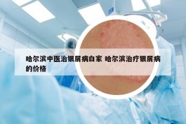 哈爾濱中醫(yī)治銀屑病白家 哈爾濱治療銀屑病的價格