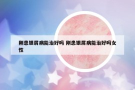 剛患銀屑病能治好嗎 剛患銀屑病能治好嗎女性