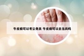 牛皮癬可以考公務(wù)員 牛皮癬可以去當(dāng)兵嗎