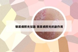 銀屑病照光儀器 銀屑病照光的副作用