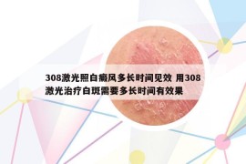 308激光照白癜風(fēng)多長(zhǎng)時(shí)間見效 用308激光治療白斑需要多長(zhǎng)時(shí)間有效果