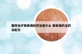 醫(yī)院治療銀屑病的藥浴是什么 銀屑病藥浴藥浴配方