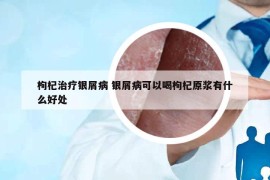 枸杞治療銀屑病 銀屑病可以喝枸杞原漿有什么好處