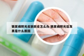 銀屑病照光皮膚脫皮怎么辦 銀屑病照光后發(fā)黑是什么原因
