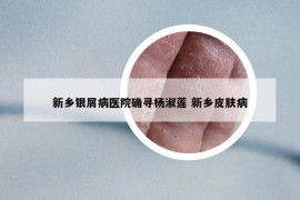 新鄉(xiāng)銀屑病醫(yī)院確尋楊淑蓮 新鄉(xiāng)皮膚病