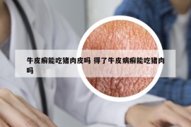 牛皮癬能吃豬肉皮嗎 得了牛皮病癬能吃豬肉嗎