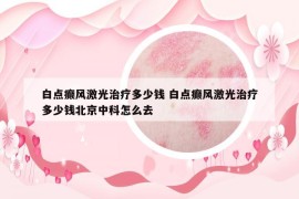 白點癲風激光治療多少錢 白點癲風激光治療多少錢北京中科怎么去