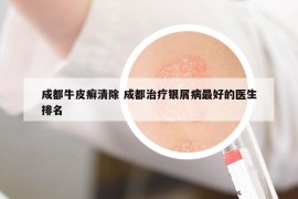 成都牛皮癬清除 成都治療銀屑病最好的醫(yī)生排名