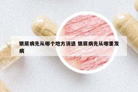 銀屑病先從哪個地方消退 銀屑病先從哪里發(fā)病