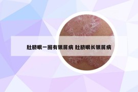 肚臍眼一圈有銀屑病 肚臍眼長銀屑病