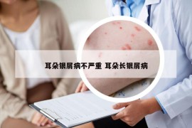耳朵銀屑病不嚴(yán)重 耳朵長(zhǎng)銀屑病