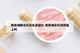 銀屑病都會(huì)長在私密部位 銀屑病會(huì)長到陰囊上嗎