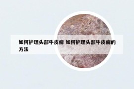 如何護(hù)理頭部牛皮癬 如何護(hù)理頭部牛皮癬的方法