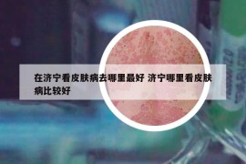 在濟(jì)寧看皮膚病去哪里最好 濟(jì)寧哪里看皮膚病比較好