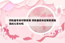 切除扁導(dǎo)體對(duì)銀屑病 切除扁桃體后銀屑病復(fù)發(fā)的幾率大嗎