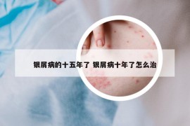 銀屑病的十五年了 銀屑病十年了怎么治