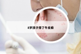 8歲孩子得了牛皮癬
