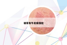 誰家有牛皮癬保險(xiǎn)