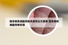 西安銀屑病醫(yī)院聯(lián)系西安北方很棒 西安銀屑病醫(yī)院哪家強