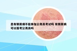 患有銀屑病不能參加公務(wù)員考試嗎 有銀屑病可以報(bào)考公務(wù)員嗎