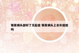 銀屑病頭部好了又起痘 銀屑病頭上會(huì)長(zhǎng)痘痘嗎