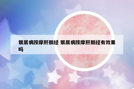 銀屑病按摩肝膽經(jīng) 銀屑病按摩肝膽經(jīng)有效果嗎