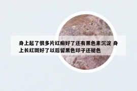 身上起了很多片紅癬好了還有黑色素沉淀 身上長(zhǎng)紅斑好了以后留黑色印子還褪色