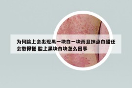 為何臉上會(huì)出現(xiàn)黑一塊白一塊而且抹點(diǎn)白醋還會(huì)撒得慌 臉上黑塊白塊怎么回事