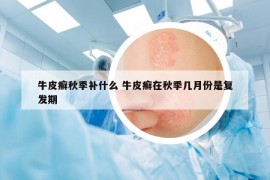 牛皮癬秋季補(bǔ)什么 牛皮癬在秋季幾月份是復(fù)發(fā)期